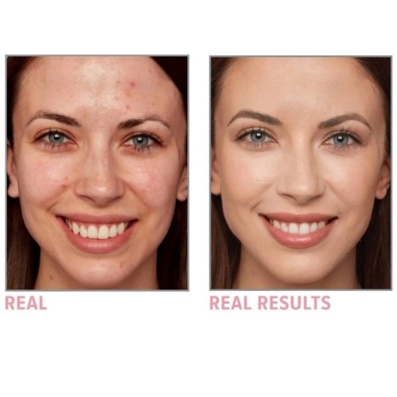 It Bye Bye Breakout Full Coverage Concealer AND Acne Treatment - Picture 7 of 8